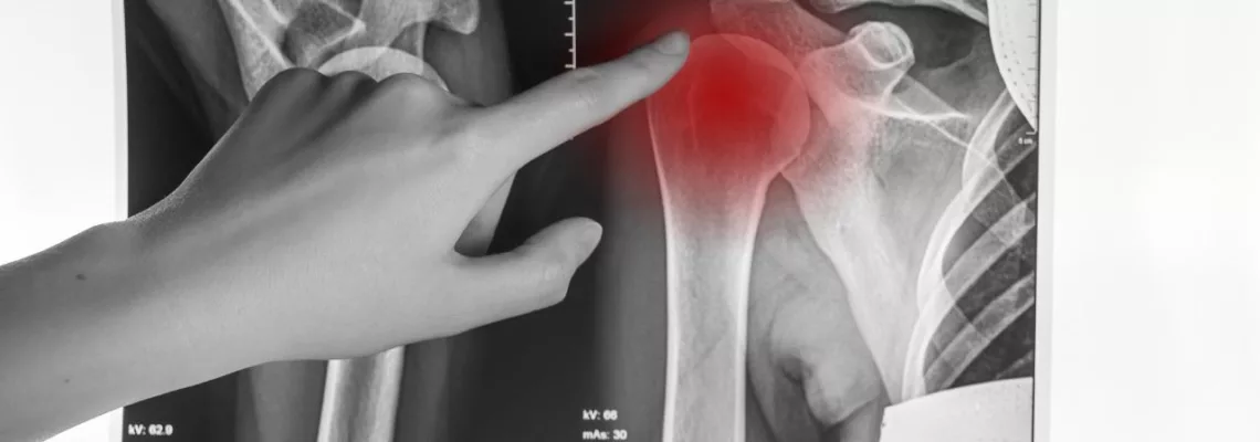 Lesiones de Hombro en Deportistas: Causas y Estrategias de Prevención