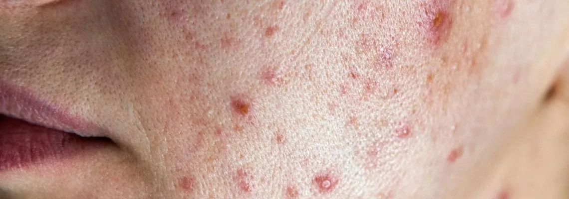 El ABC del Acné: Causas, Tratamiento y Prevención