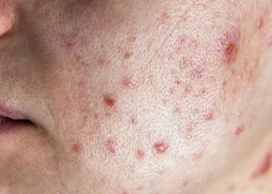 El ABC del Acné: Causas, Tratamiento y Prevención