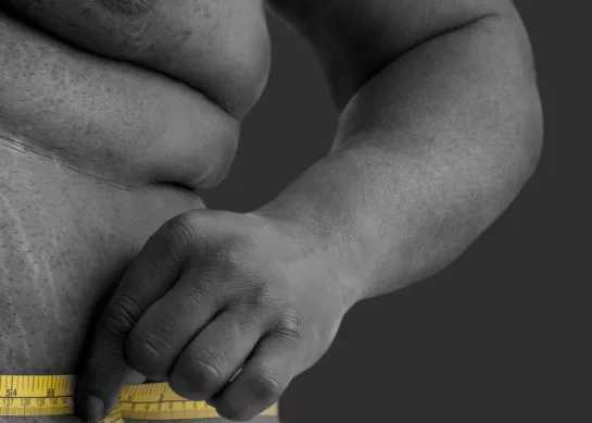 Obesidad y Enfermedades Crónicas: La Relación entre el Exceso de Peso y la Salud