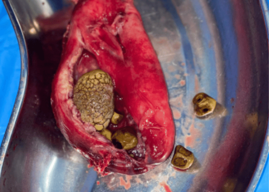 Cálculos en la vesícula