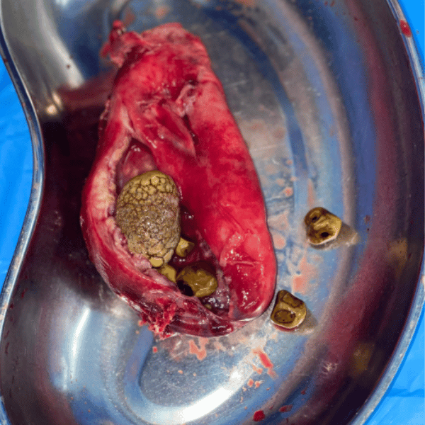 Cálculos en la vesícula