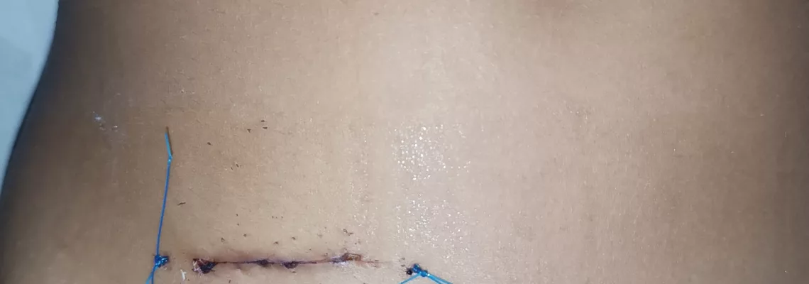 Apendicentomia convencional (abierta ) por apendicitis aguda