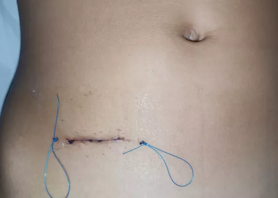 Apendicentomia convencional (abierta ) por apendicitis aguda