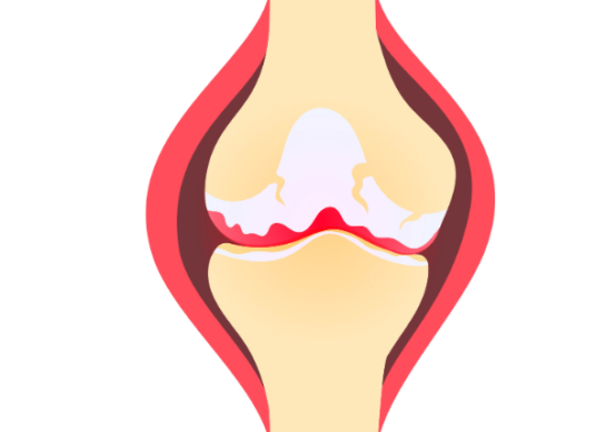 Lesión de Menisco en Atletas