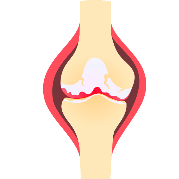 Lesión de Menisco en Atletas